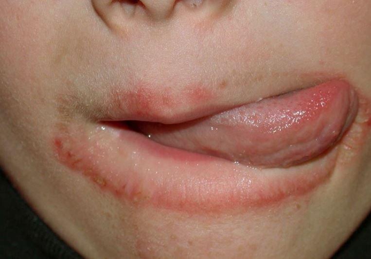 Treating Contact Dermatitis On Lips