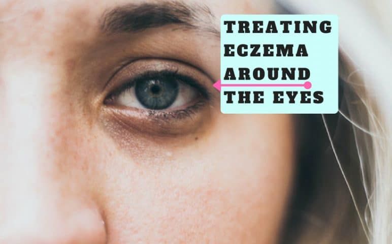 Treating Eczema Around The Eyes (Natural Remedies)