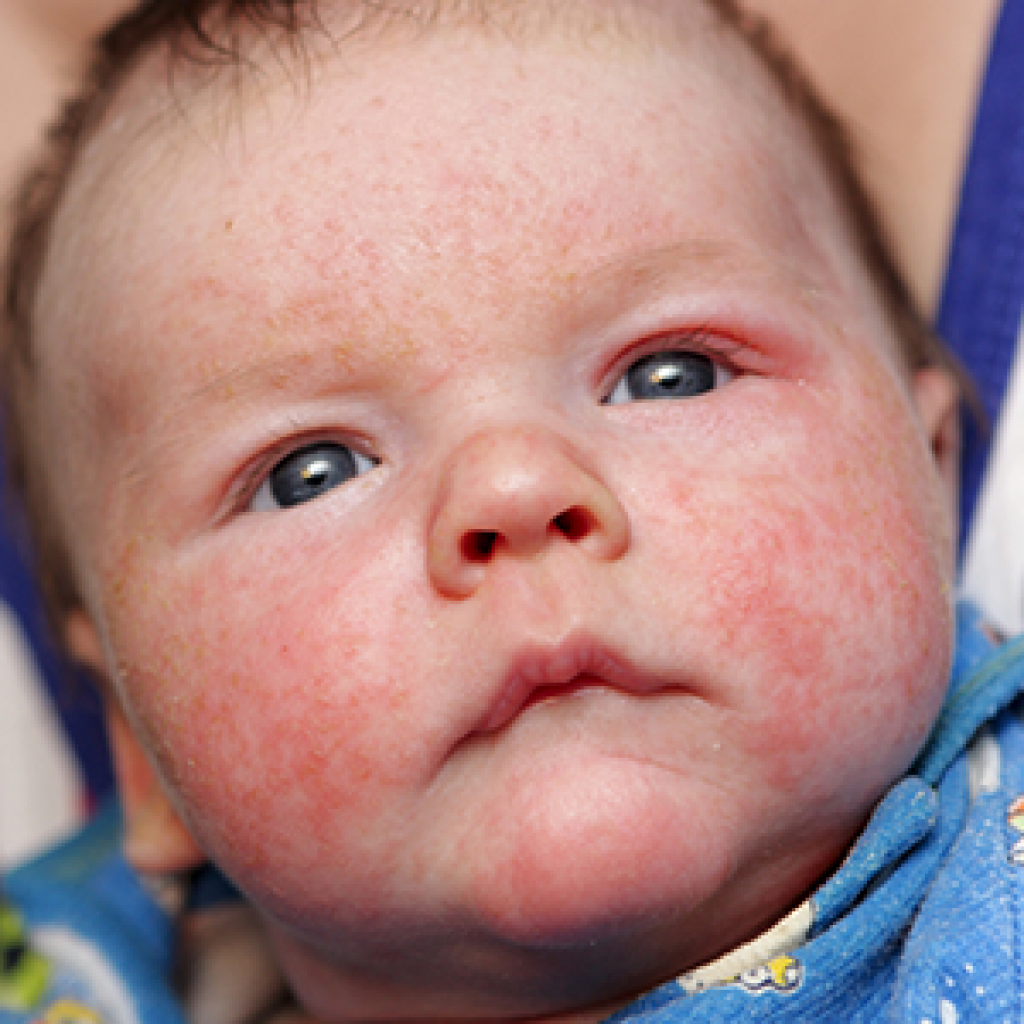 Treating Eczema in Babies