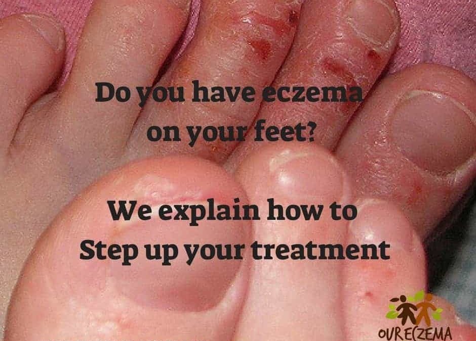 Treating Eczema On Your Feet
