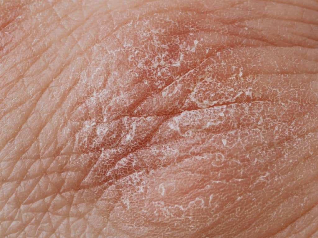Treatment for mild to severe eczema (atopic dermatitis ...
