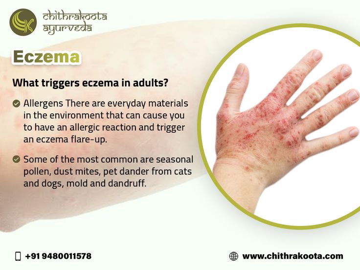 triggers eczema in adults