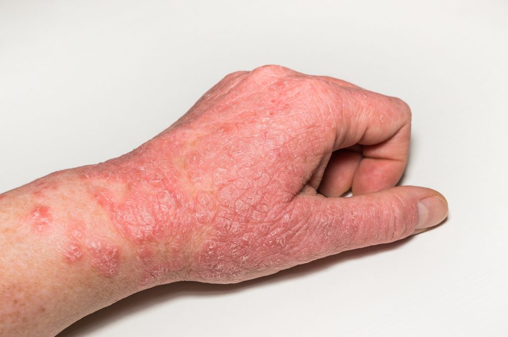 Types and treatments: Atopic dermatitis