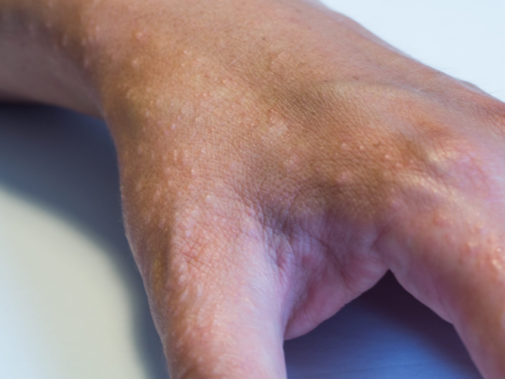 Types of Eczema and Their Symptoms