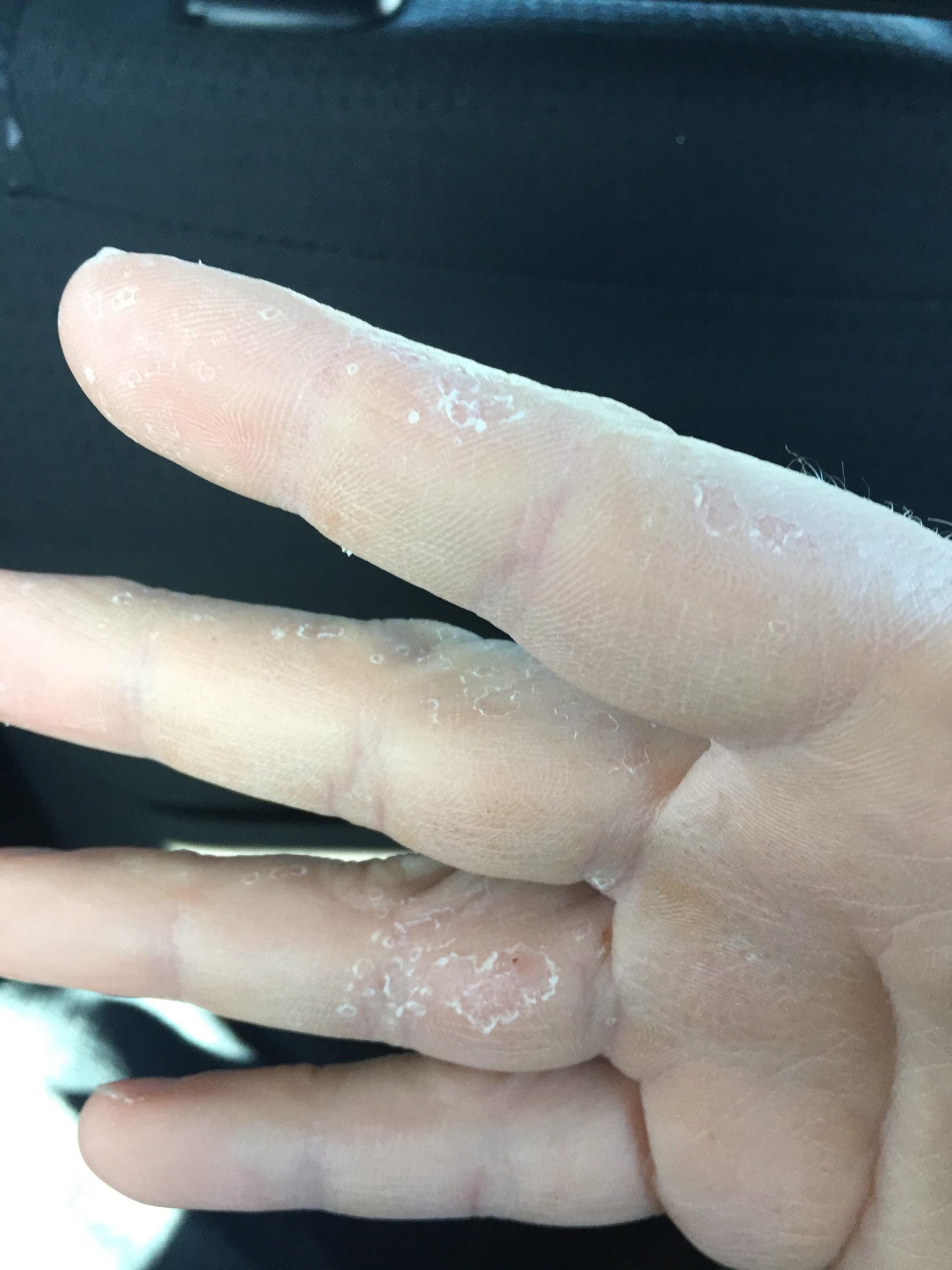 Update: dyshidrotic eczema is gone, but this is the aftermath : popping