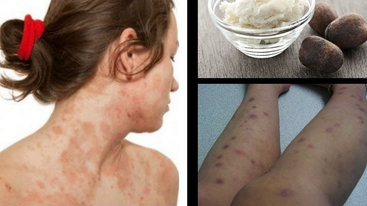 Use This 5 Effective Home Remedies to Cure Eczema Scars ...