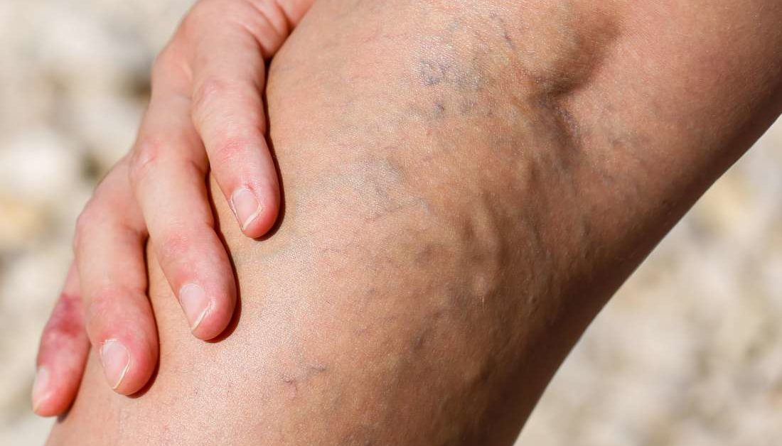 Varicose eczema, or stasis dermatitis: Symptoms, causes, and treatment