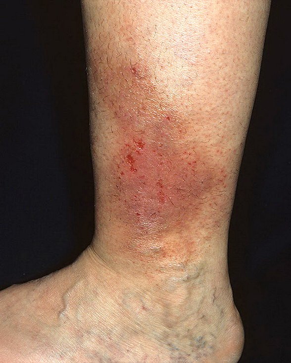 Venous Eczema on Legs Pictures  174 Photos &  Images / illnessee.com