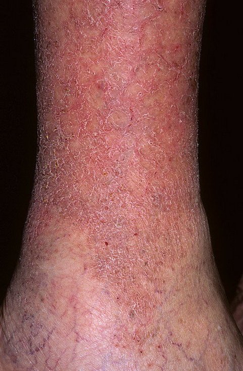 Venous Eczema on Legs Pictures â 174 Photos &  Images / illnessee.com