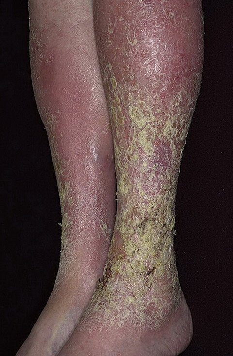 Venous Eczema on Legs Pictures â 174 Photos &  Images ...