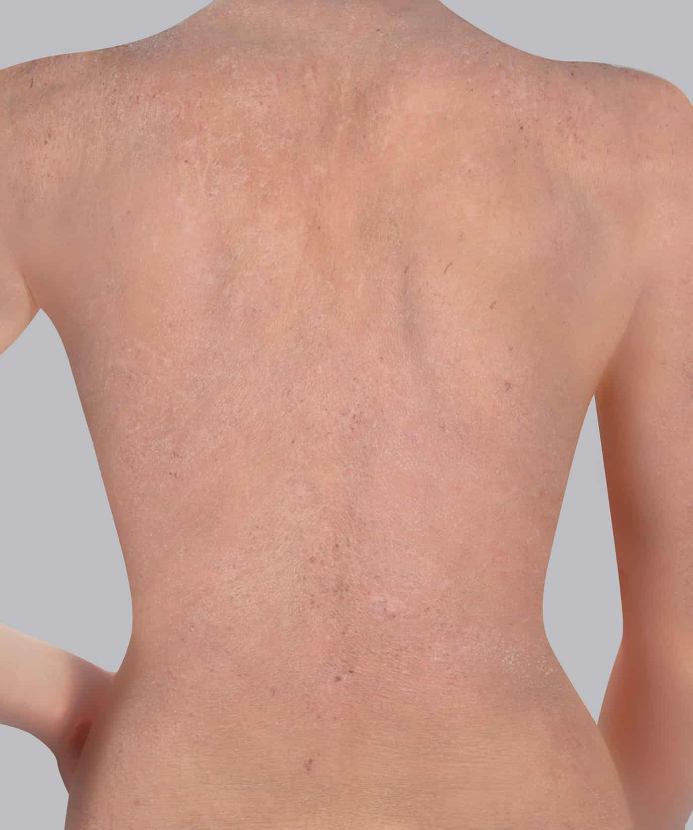 [View 42+] Eczema Mild Back
