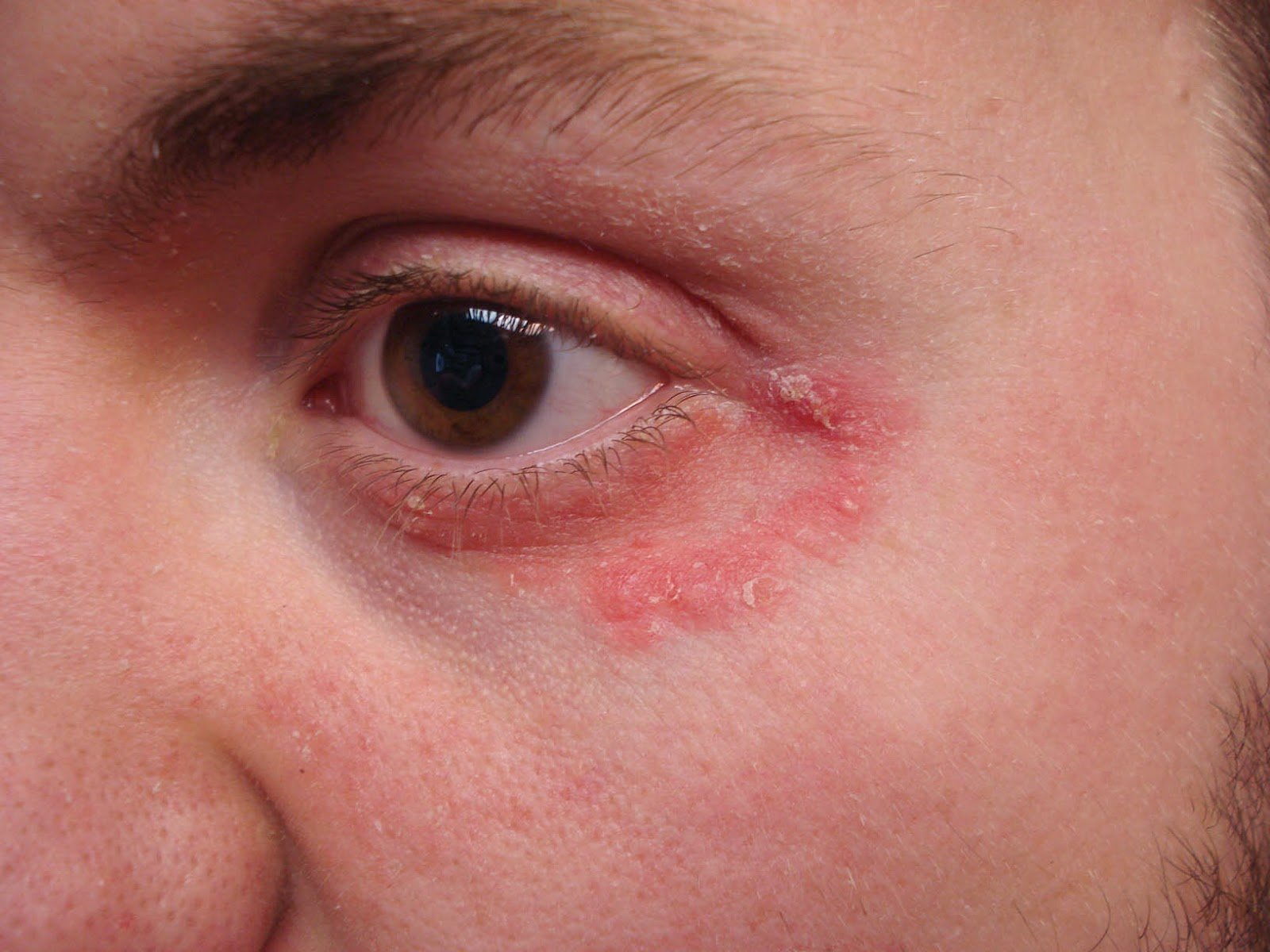 VIRTUAL GRAND ROUNDS IN DERMATOLOGY 2.0: Unusual Eyelid Dermatitis