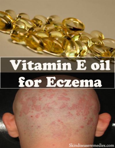 Vitamin E Oil for Eczema  3 Awesome Ways