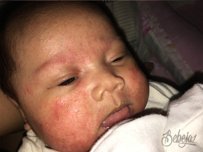 Vlog: My baby has cradle cap or eczema?!