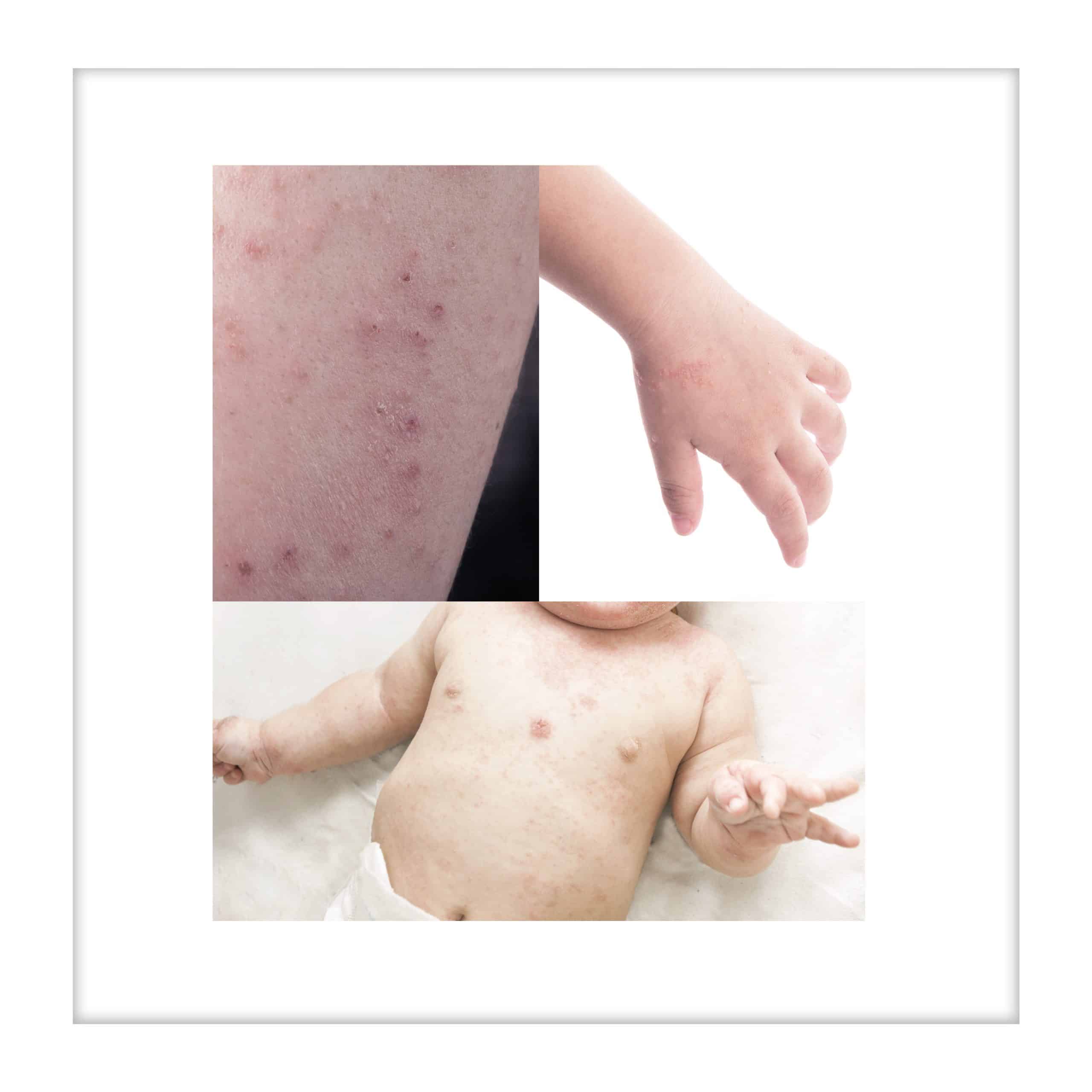 VMV InSKIN Â» My Baby Has Eczema