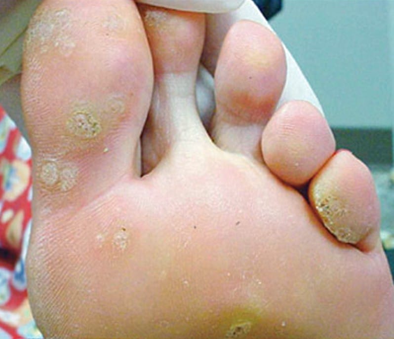 Warts on Feet