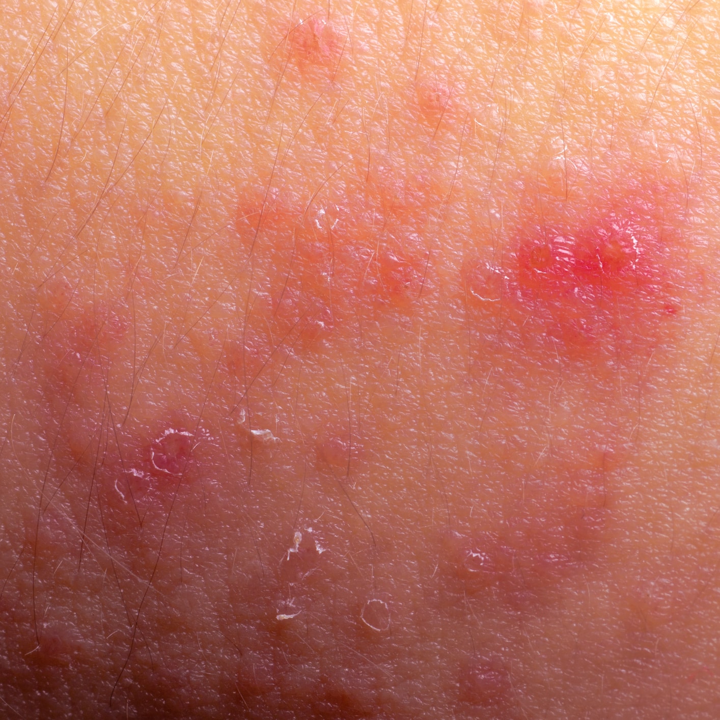 Washington DC Allergist: Eczema (atopic dermatitis)