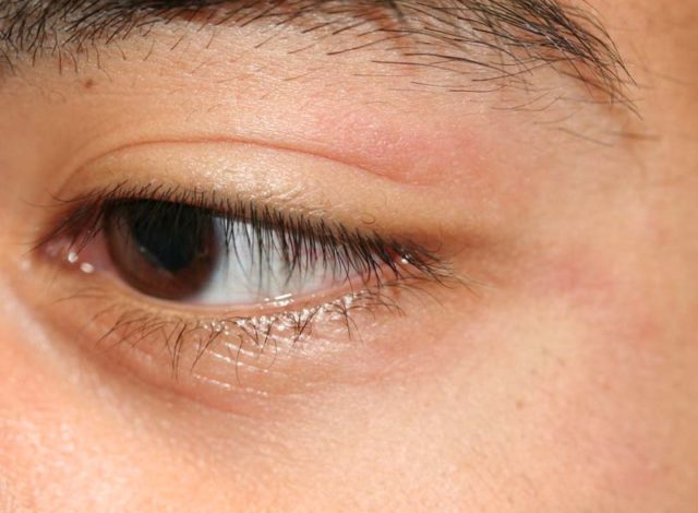Ways to Treat Eczema on Eyelids