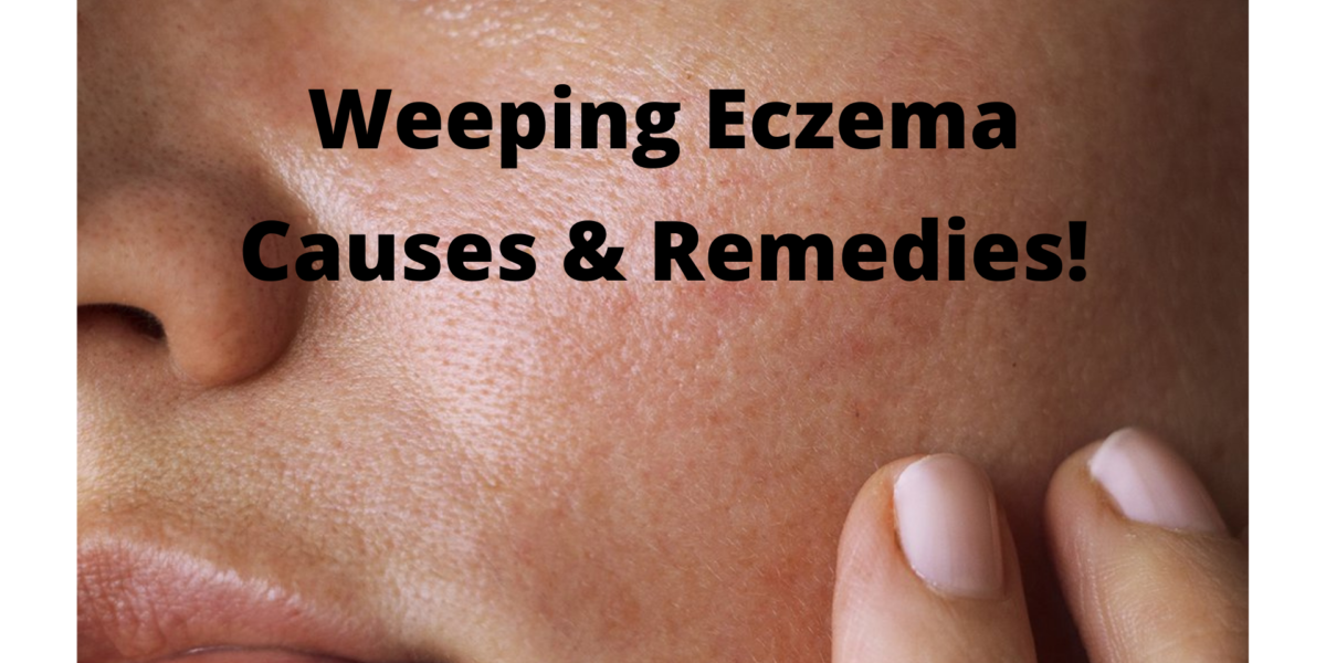 Weeping Eczema