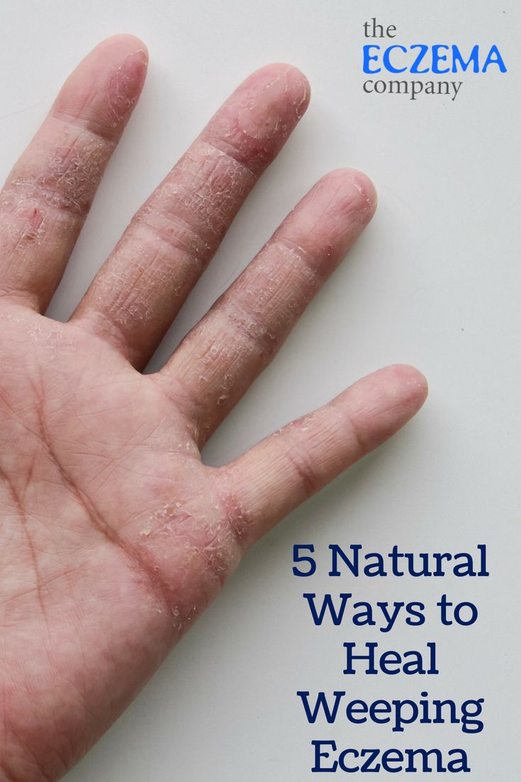 Weeping Eczema: Natural Ways to Heal