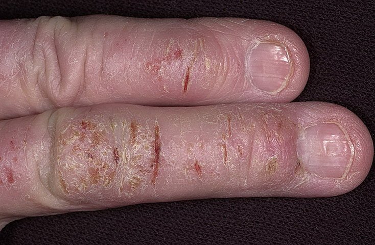 Weeping Eczema on Hands Pictures  41 Photos &  Images ...