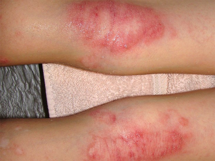 Weeping eczema: Symptoms, causes, and treatment