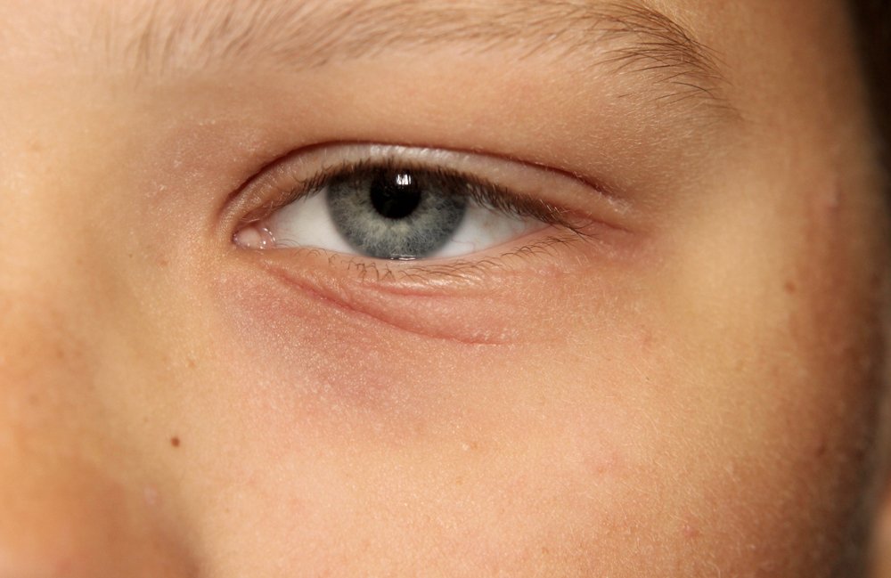 What are the common causes of Eyelid Eczema