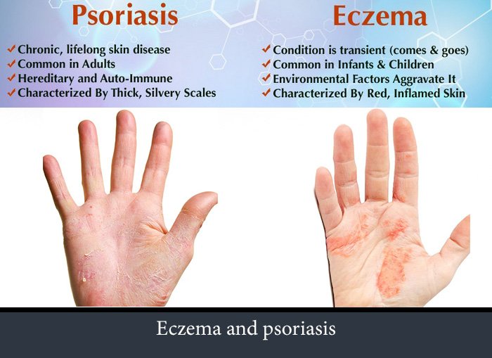 What are the differences between eczema and psoriasis ...