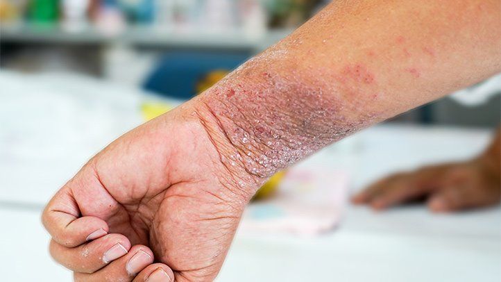 What Are the Symptoms of Eczema (Atopic Dermatitis)?