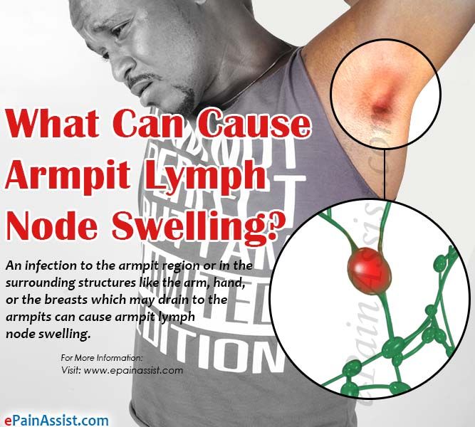 What Can Cause Armpit Lymph Node Swelling?