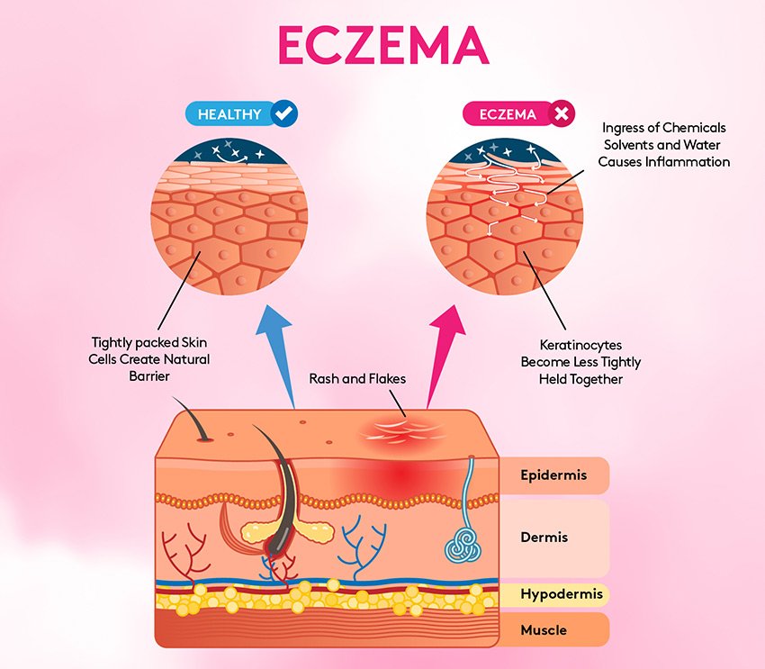 What Causes Eczema and How To Treat It Like A Derm