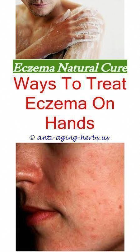 what causes eczema in adults nitrile gloves eczema