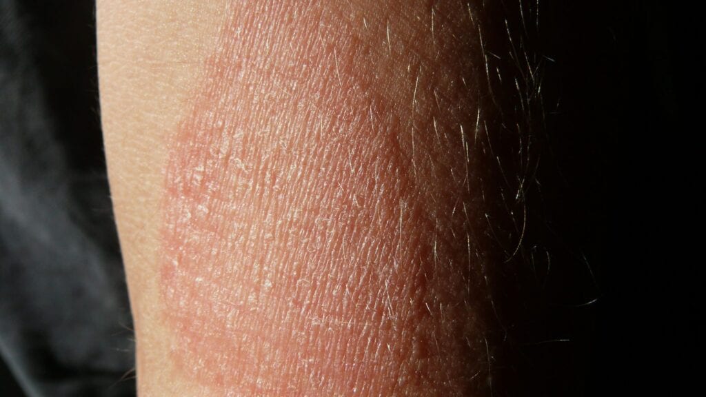 What Causes Eczema? Symptoms, Causes, and Treatment