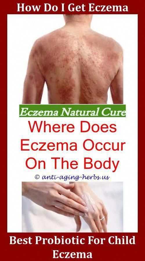 What Cream Treats Eczema,eczema symptoms and causes how to ...