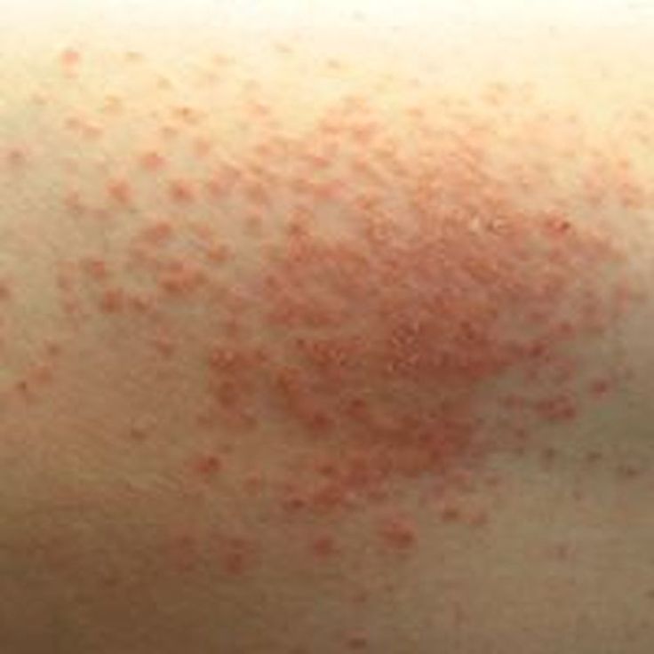 What Does Eczema Look Like in Different Stages?