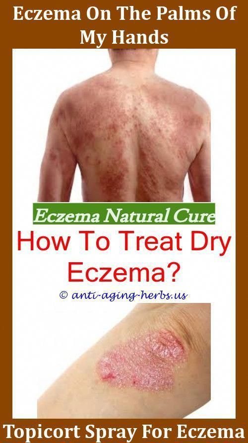 What Does Eczema Look Like On Face