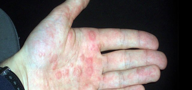 What Does Eczema On Your Hands Look Like