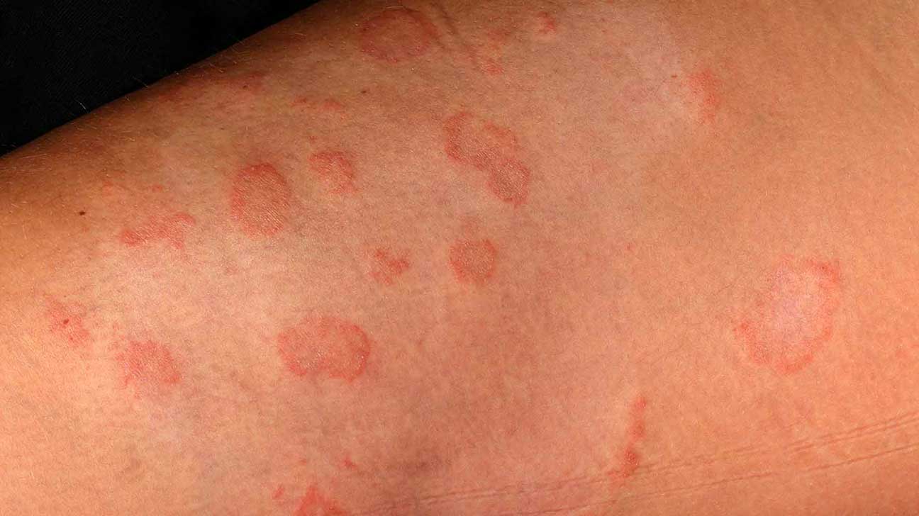 What does ringworm rash look like