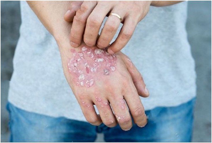 What does vascular eczema look like?