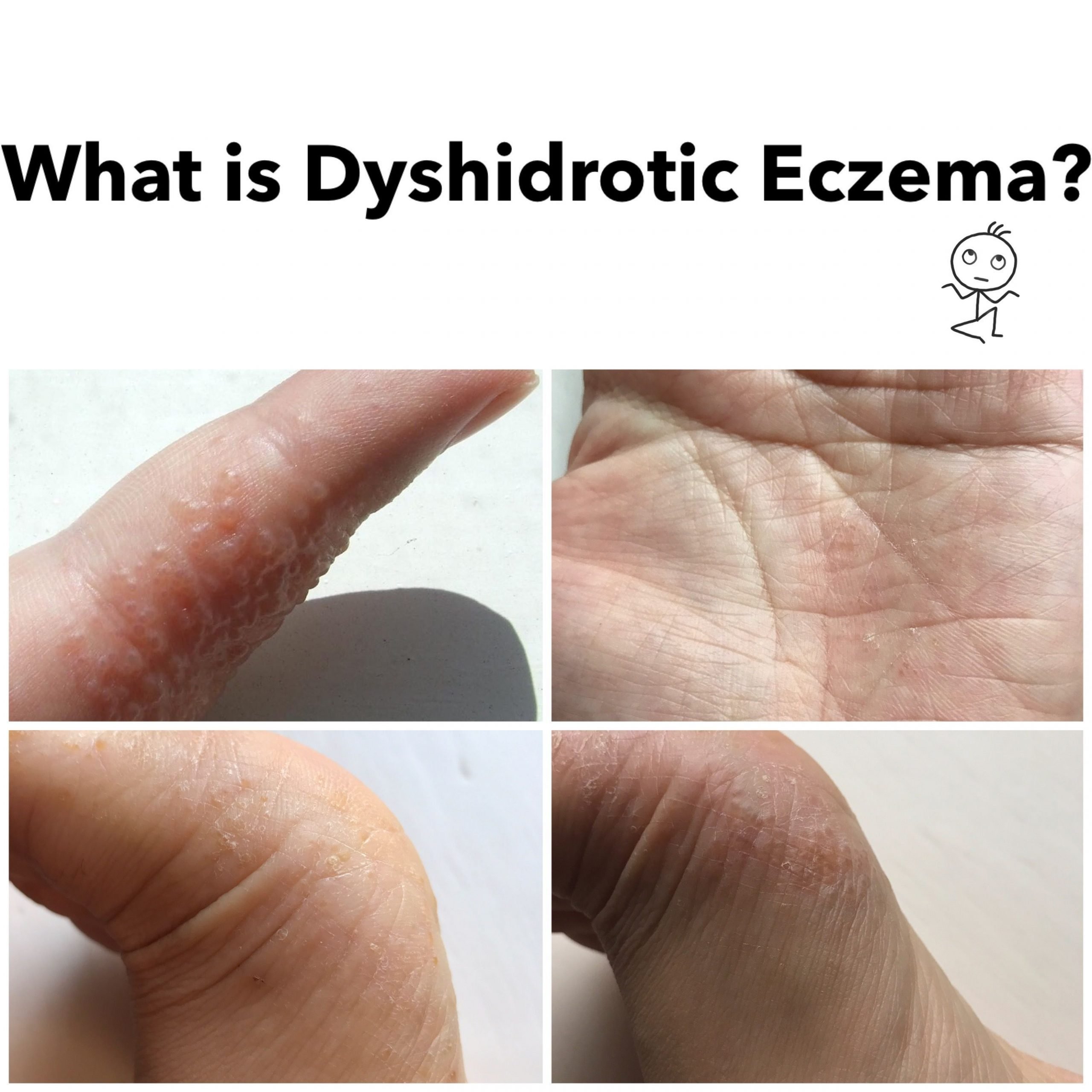 What is Dyshidrotic Eczema? Blisters on fingers, hands, and feet. # ...