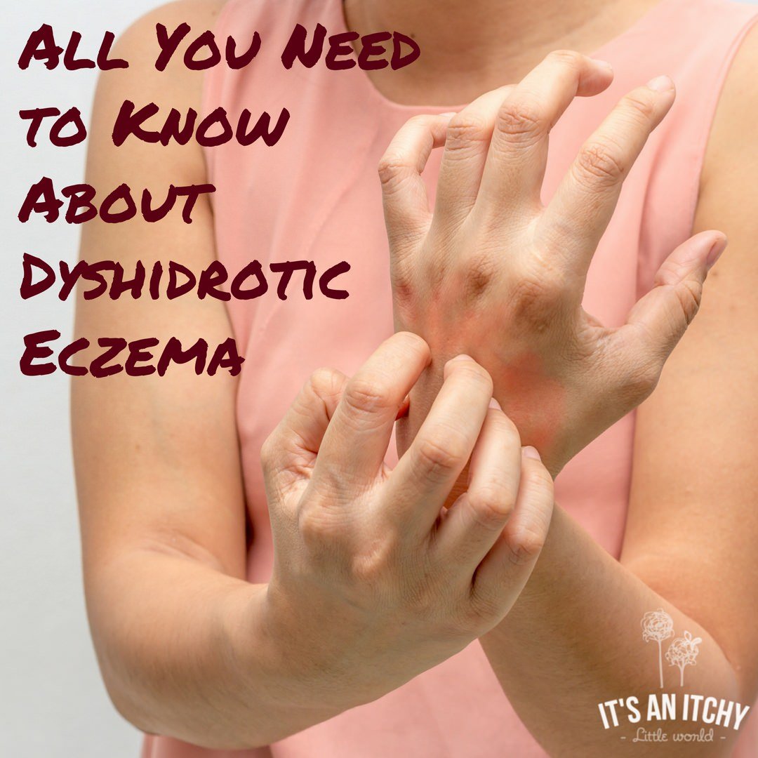 What is Dyshidrotic Eczema?