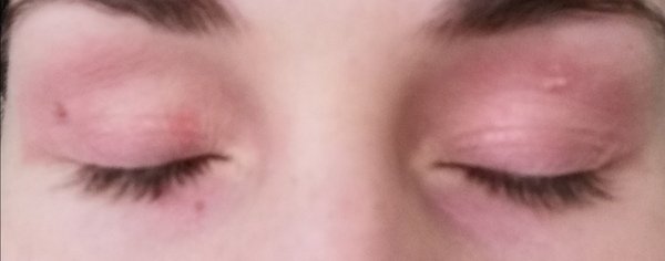 What is going on with the skin around my eyes