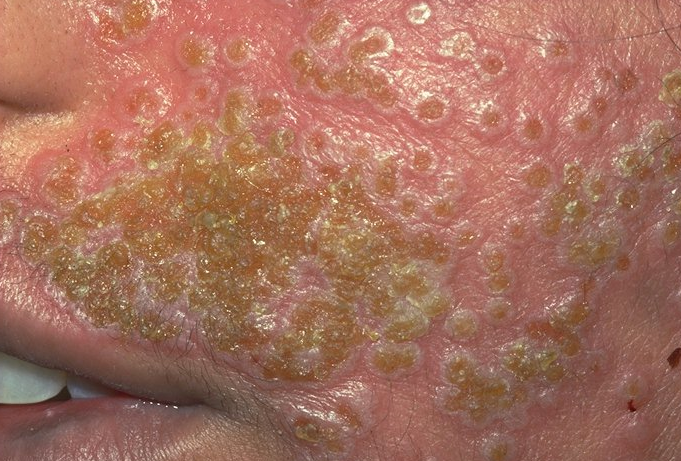 What is Herpeticum Eczema and how does it occur?