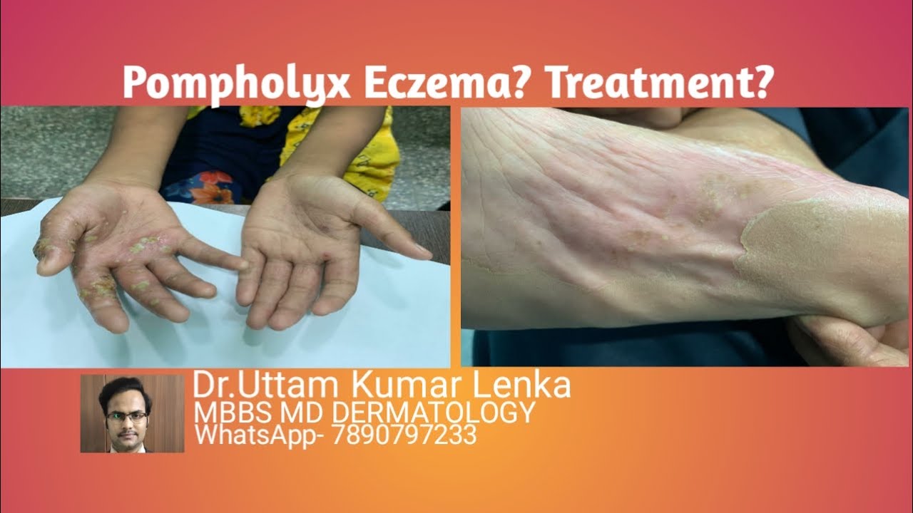 What is pompholyx eczema/Treatment?(Pompholyx eczema kya hota he ...