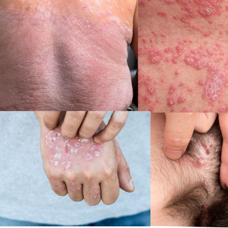 What is Psoriasis? Explained in 2021