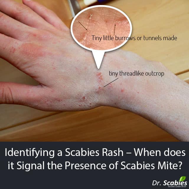 What is scabies rash?