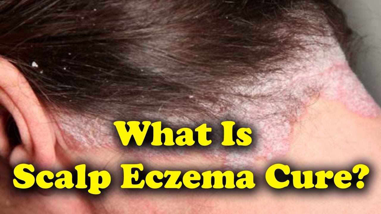 What Is Scalp Eczema Cure, Symptoms and Treatments