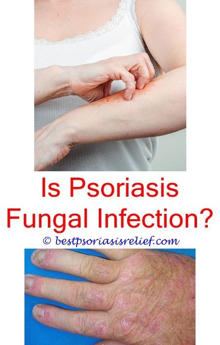 What Is The Best Treatment For Psoriasis On Hands