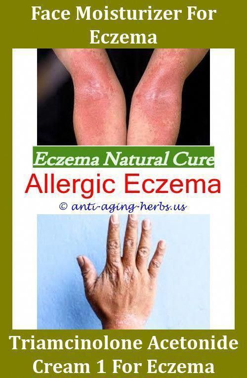 What To Use For Eczema On Neck How To Relieve Eczema On Face,eczema ...