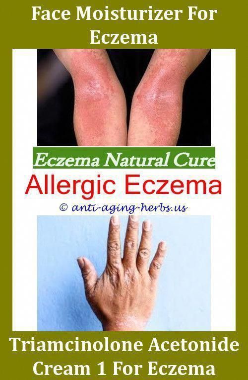 What To Use For Eczema On Neck How To Relieve Eczema On ...